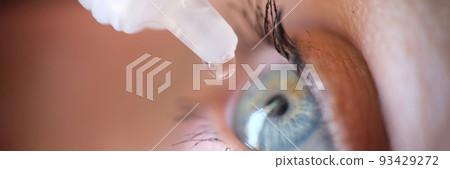 Drops from vial dripping into woman eye closeup 93429272