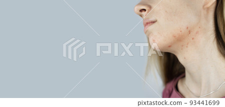 Girl shows acne on her face. Acne on the neck. Demodicosis on the chin. Redness and rash on the woman face. Acne and redness treatment. Large blisters, pits and enlarged pores Girl shows acne on her face. Acne on the neck. Demodicosis on the chin. Redness and rash on the woman face. Acne and redness treatment. Large blisters, pits and enlarged pores 93441699