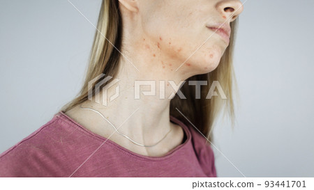 Girl shows acne on her face. Acne on the neck. Demodicosis on the chin. Redness and rash on the woman face. Acne and redness treatment. Large blisters, pits and enlarged pores 93441701