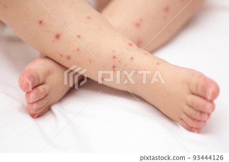 手足口病寶寶腳 手足口病寶寶腳 93444126