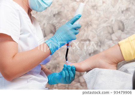 Professional pedicure. Podologist installs a titanium thread on the big toe. Correction of ingrown toenail. The concept of podology and chiropody 93479906
