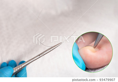 A podologist in blue gloves holds a titanium thread with tweezers. Close up. Zoomed area with podiatry procedure. White background. The concept of podology and chiropody A podologist in blue gloves holds a titanium thread with tweezers. Close up. Zoomed area with podiatry procedure. White background. The concept of podology and chiropody 93479907