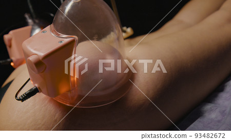 Woman Receiving Vacuum Cupping Device, Butt Skin Lifting Therapy Pump Lifting Enhancer Cup Machine Massager, Beauty Tool, Salon SPA, Hip Shaping 93482672