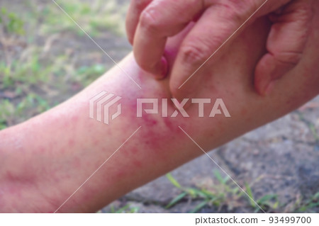 Blurred images while scratching hands-on dermatitis, viral dermatitis, itchy dermatitis, hives, dermatitis in the body, skin problems, allergic skin redness, and peeling of the skin on the legs. 93499700