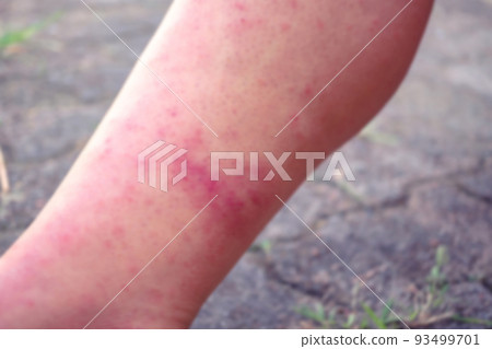 Blurred images for dermatitis, viral dermatitis rash dermatitis of pruritus, dermatitis urticaria in the body health problems allergies redness, and peeling of the skin on the legs. 93499701