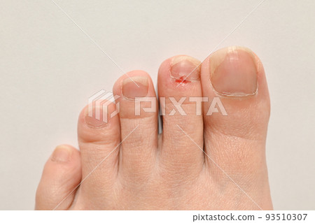toe injury 93510307