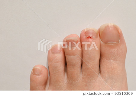 腳趾受傷 93510309