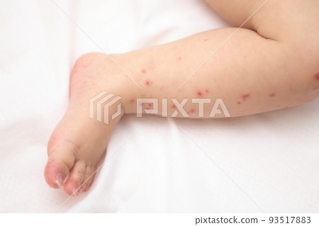 baby feet with hand foot and mouth disease baby feet with hand foot and mouth disease 93517883