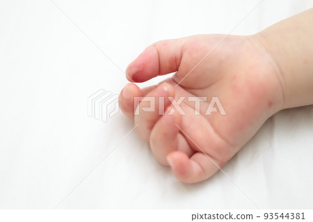嬰兒手足口病 嬰兒手足口病 93544381