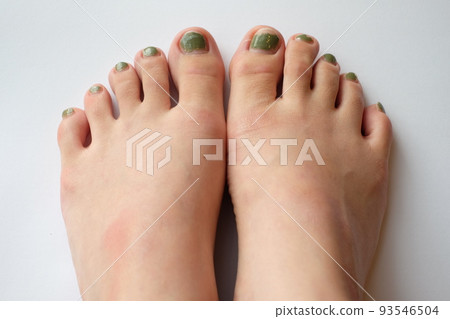 broken pedicure 93546504