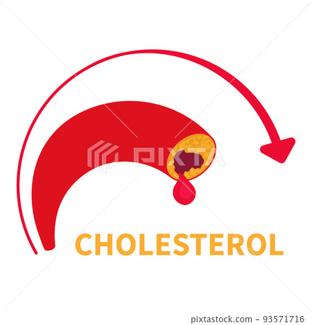 High cholesterol level of blocked blood vessel diagram 93571716