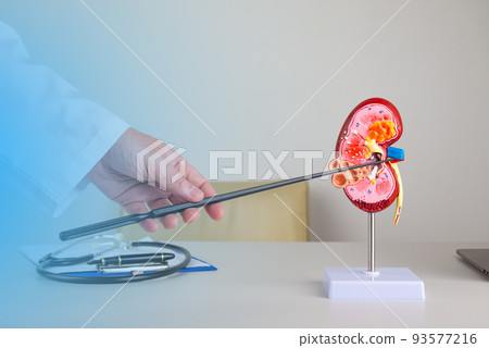 doctor nephrologist pointing at fibrous plague in artery on a kidney mockup on his desktop 93577216