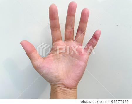 Eczema herpetiformis, dyshidrotic eczema, dermatitis, inflammatory hand eczema, poor metabolism, allergic dermatitis in patients with atopic dermatitis 93577985