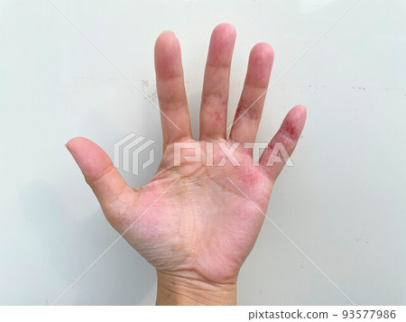 Eczema herpetiformis, dyshidrotic eczema, dermatitis, inflammatory hand eczema, poor metabolism, allergic dermatitis in patients with atopic dermatitis Eczema herpetiformis, dyshidrotic eczema, dermatitis, inflammatory hand eczema, poor metabolism, allergic dermatitis in patients with atopic dermatitis 93577986