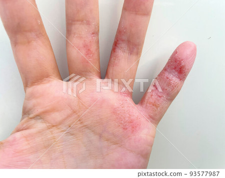 Eczema herpetiformis, dyshidrotic eczema, dermatitis, inflammatory hand eczema, poor metabolism, allergic dermatitis in patients with atopic dermatitis Eczema herpetiformis, dyshidrotic eczema, dermatitis, inflammatory hand eczema, poor metabolism, allergic dermatitis in patients with atopic dermatitis 93577987