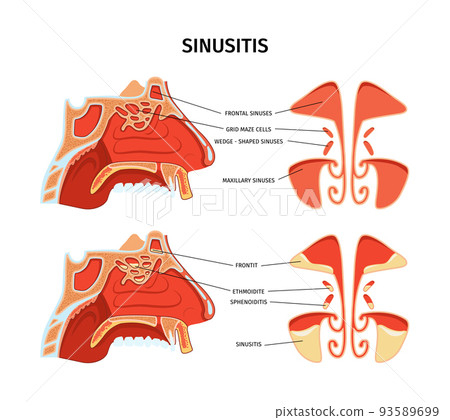 Sinusitis Infographics Illustration 93589699