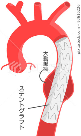 Stent graft interpolation 93616226