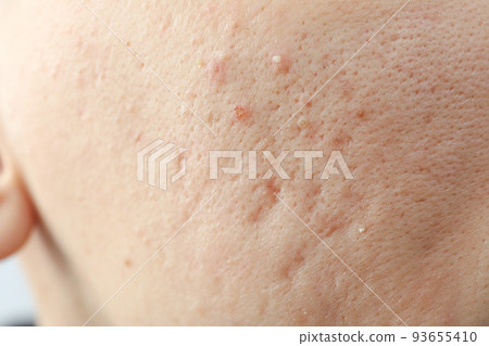 Concept of skin care with problem skin, close up Concept of skin care with problem skin, close up 93655410