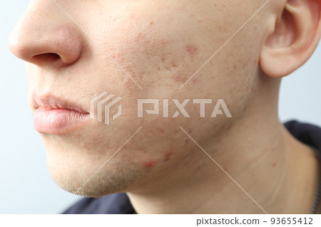 Concept of skin care with problem skin, close up Concept of skin care with problem skin, close up 93655412