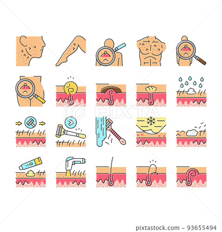 Ingrown Hair Problem Treatment Icons Set Vector Ingrown Hair Problem Treatment Icons Set Vector 93655494