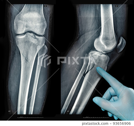 Xray images showing real fracture of leg bone under the knee after injury 93656906
