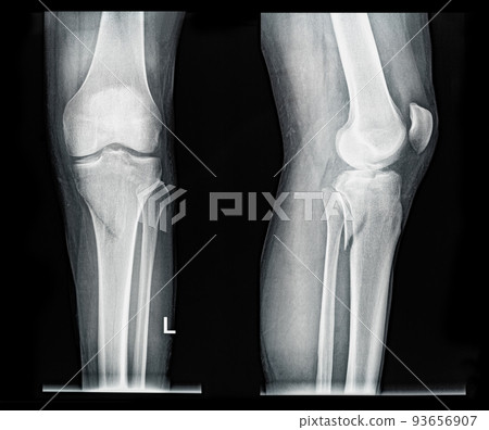 Xray MRI images showing real fracture of leg bone under the knee after injury Xray MRI images showing real fracture of leg bone under the knee after injury 93656907
