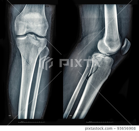 Xray images showing real fracture of leg bone under the knee after injury 93656908