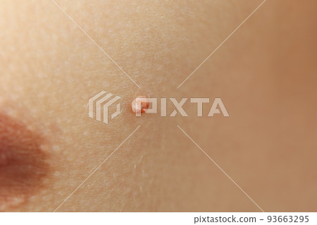 Concept of body care with skin with papilloma or mole 93663295