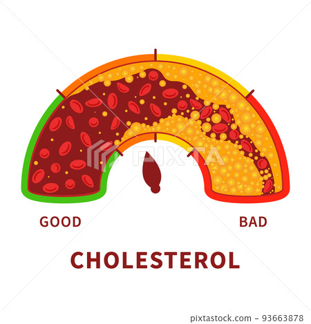Cholesterol level meter gauge with blood vessel diagram 93663878