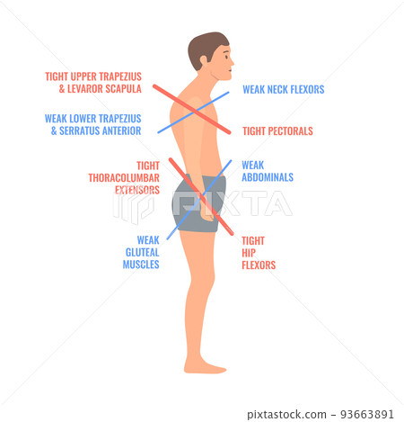 Lower and upper crossed syndrome body diagram 93663891