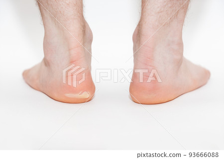 Two male feet with a burst callus. Close-up. White background. The concept of foot care and podology Two male feet with a burst callus. Close-up. White background. The concept of foot care and podology 93666088