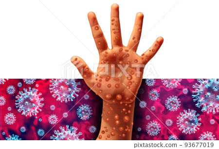 Monkeypox Infection Outbreak 93677019