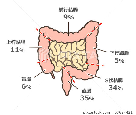 大腸癌多發部位圖解 大腸癌多發部位圖解 93684421