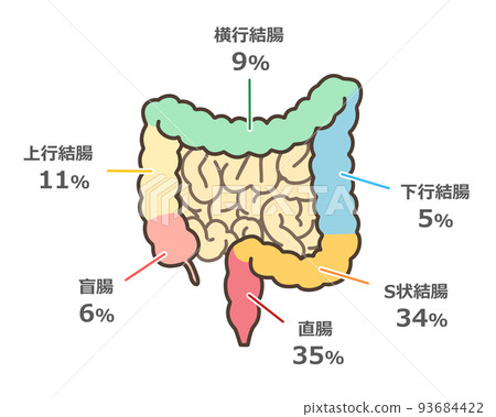 大腸癌多發部位圖解 93684422