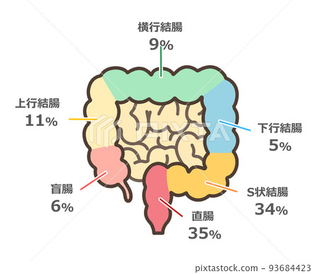 大腸癌多發部位圖解 93684423