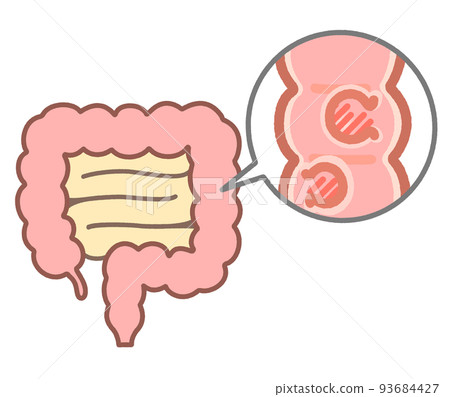 Explanation illustration of colon polyps Explanation illustration of colon polyps 93684427