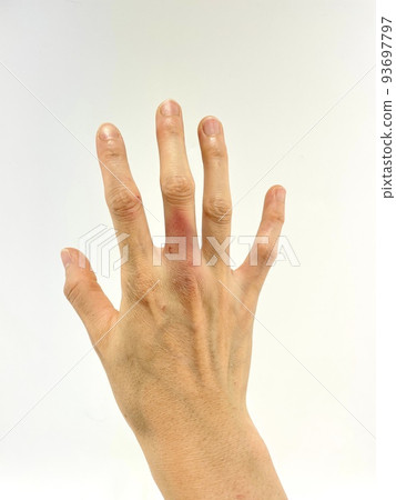 The middle finger of the right hand that bleeds internally due to a bite wound The middle finger of the right hand that bleeds internally due to a bite wound 93697797