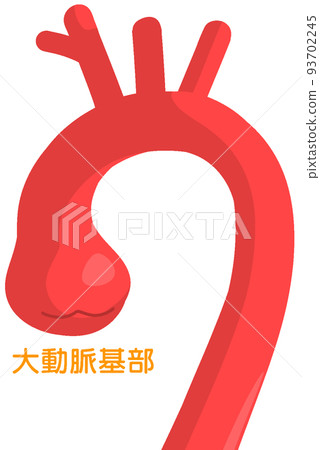 Aortic annulus dilatation 93702245