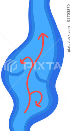 Varicose vein Varicose vein 93703870