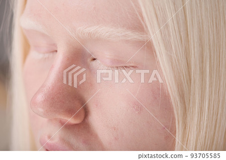 Close-up of young albino girl with natural appearance with white eyebrows and eyelashes 93705585