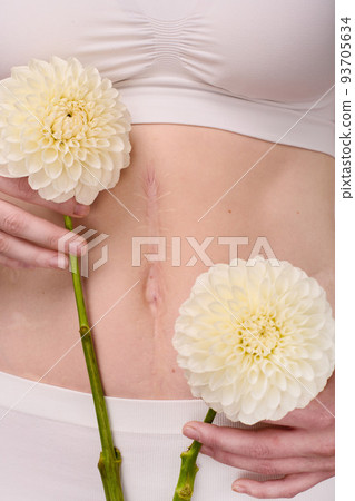 Close-up of young woman with scar on her body holding beautiful flowers in front of her 93705634