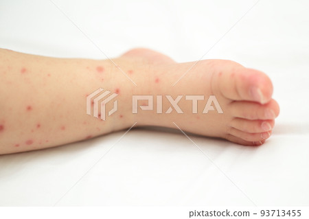 手足口病寶寶腳 93713455