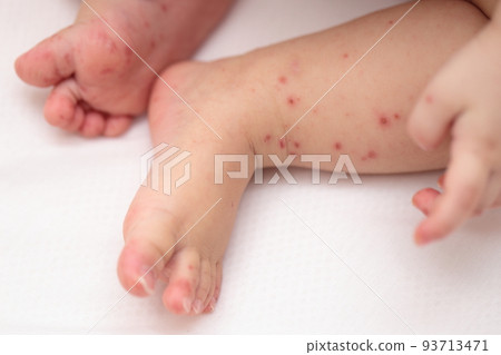手足口病寶寶腳 手足口病寶寶腳 93713471