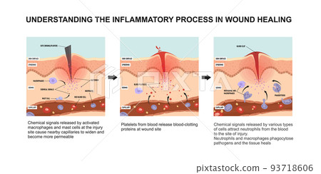 Understanding The Inflammatory Process In Wound - Stock Illustration 