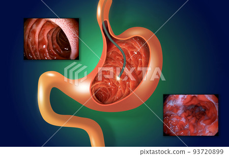 Digestive endoscopy or gastroscopy. Performing a gastroscopy procedure. Diagnostics of gastric diseases. Stomach health. Medical concept 93720899