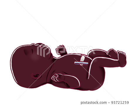 新生兒臍帶剪斷後圖解 新生兒臍帶剪斷後圖解 93721259