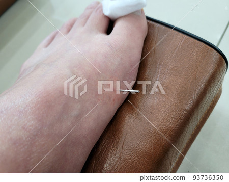 Oriental acupuncture treatment (acupuncture treatment) 93736350