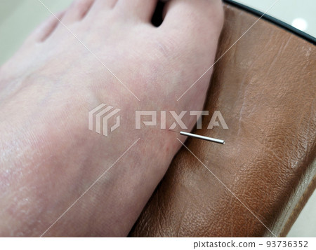 Oriental acupuncture treatment (acupuncture treatment) 93736352