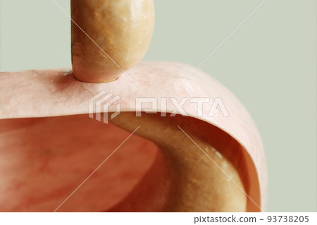 Axial hiatus hernia type 1 - entrance to the stomach via the diaphragm - 3D rendering Axial hiatus hernia type 1 - entrance to the stomach via the diaphragm - 3D rendering 93738205