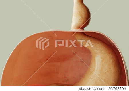 Axial hiatus hernia type 1 - entrance to the stomach via the diaphragm - 3D rendering Axial hiatus hernia type 1 - entrance to the stomach via the diaphragm - 3D rendering 93762504